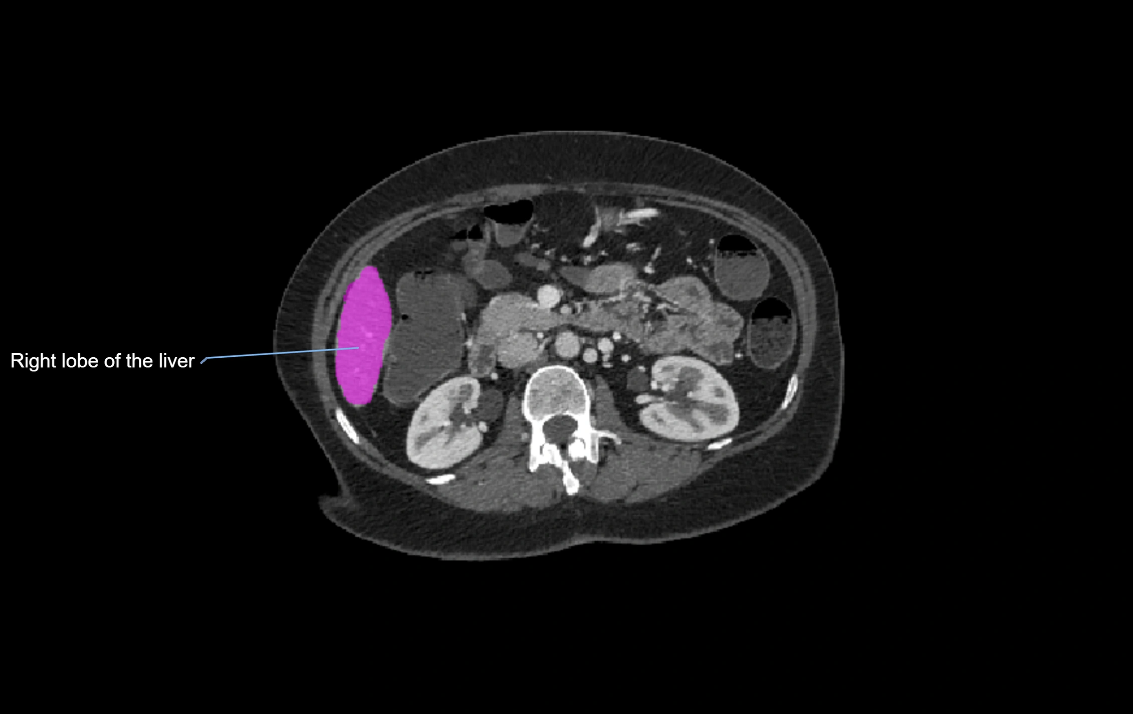 CT lliver lobes axial cross sectional anatomy labelled image -00017.webp